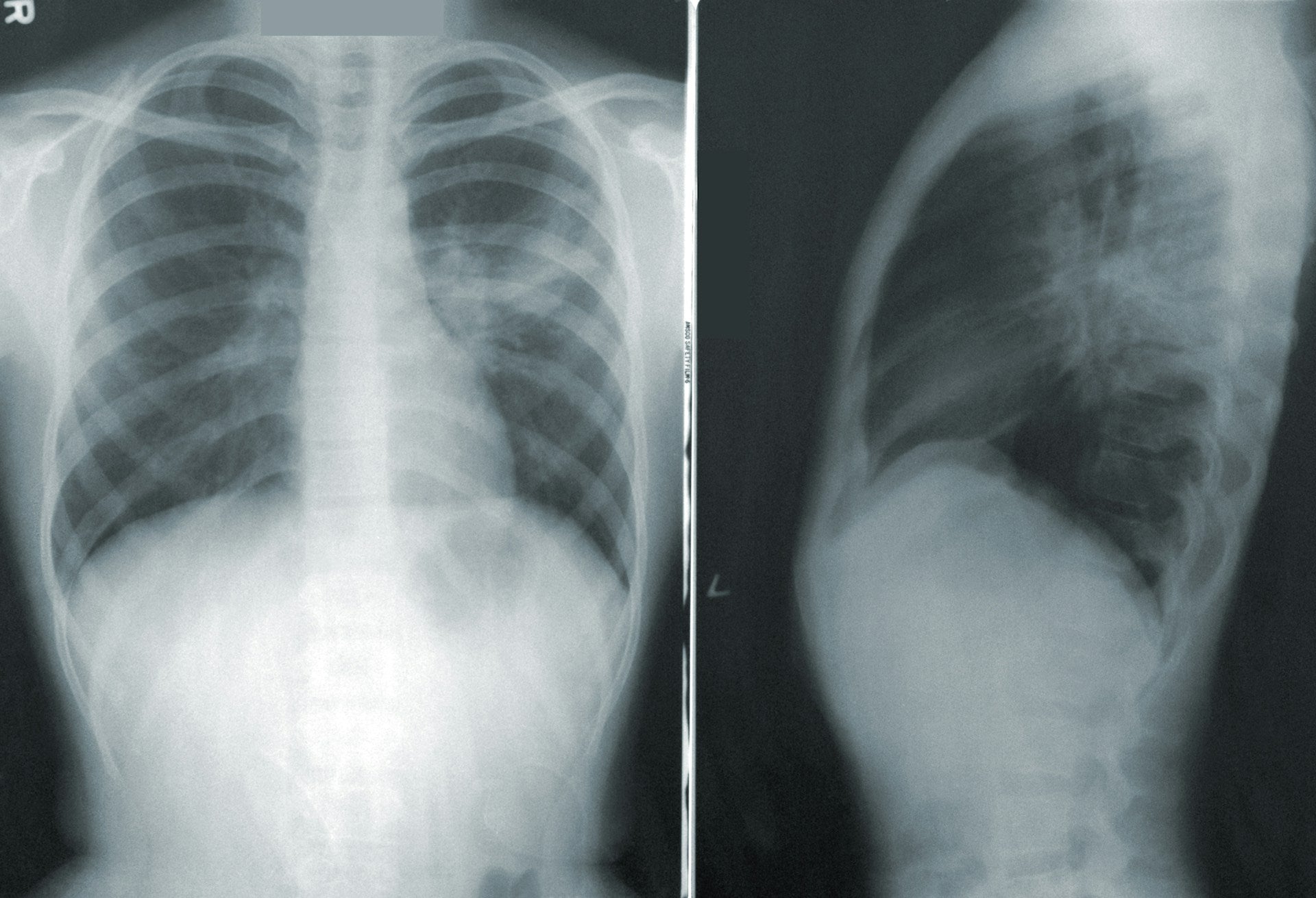 How Bioregulator Lungs Supports Respiratory Health